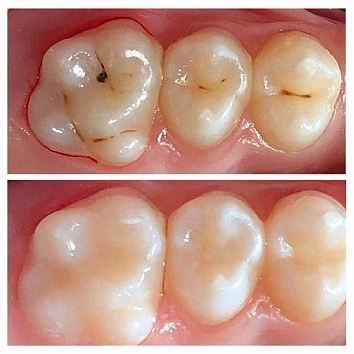 Клинический случай: кариес постоянного жевательного зуба.