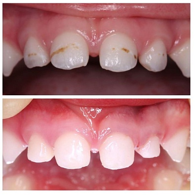 Клинический случай: лечение зубов у 3-летнего ребенка без наркоза. 