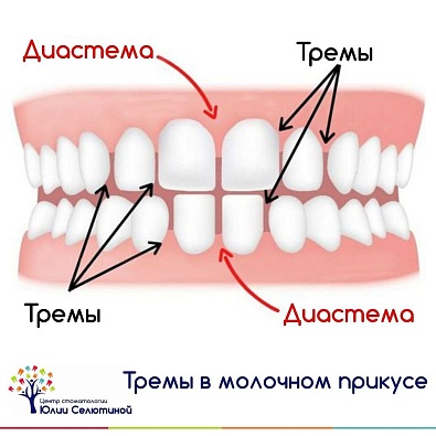 Расстояние между зубами: когда это норма? 
