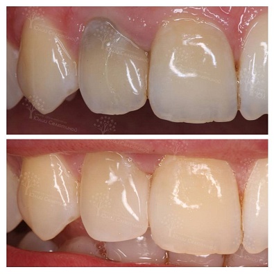 Как реставрация одного зуба меняет улыбку.