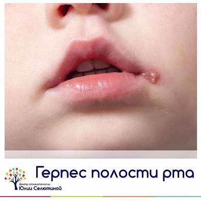 Герпес на губах причины и симптомы - Стоматология Москвы 