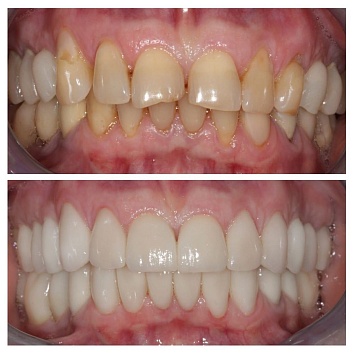 Клинический случай: тотальная стоматологическая реабилитация. 