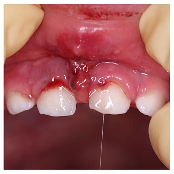 Травмы слизистой оболочки: повреждение уздечки верхней губы.