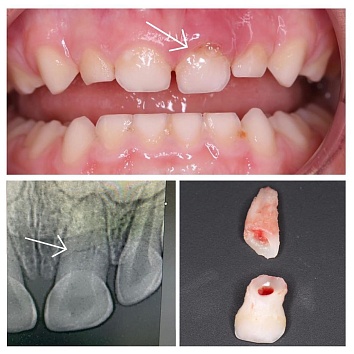 Травмы молочных зубов: перелом корня зуба. 