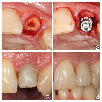 Имплантация и протезирование центрального зуба 