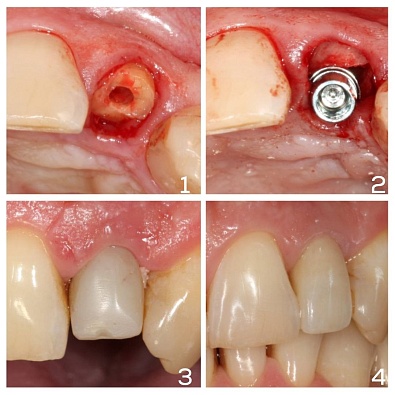 Имплантация и протезирование центрального зуба 