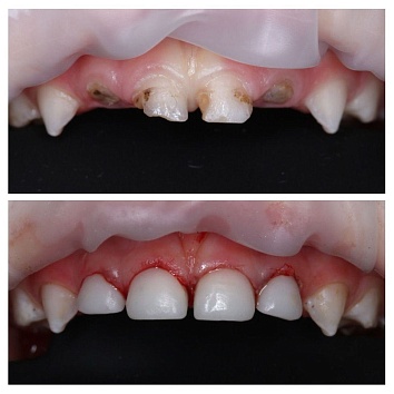 Восстановление центральных зубов под наркозом. 