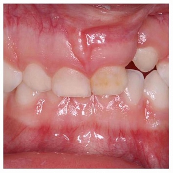 Расщелина верхней губы и альвеолярного отростка: чем чревато, с точки зрения стоматологии?