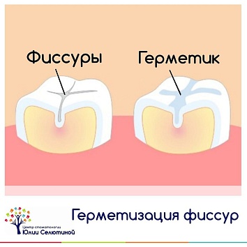 Как защитить зубы от кариеса? 