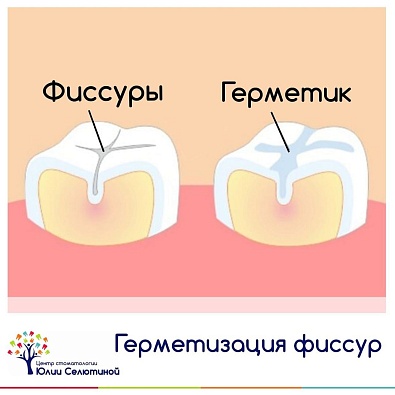 Как защитить зубы от кариеса? 