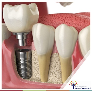 Имплантация зубов: рекомендации по подготовке к операции 