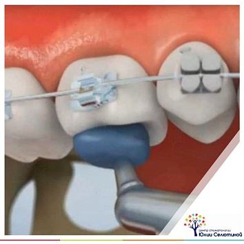 Что за синие пломбы крепят на зубы во время брекет-лечения?