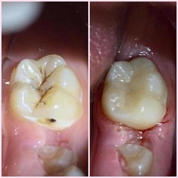 Лечение "шестых" зубов