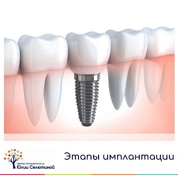 Этапы имплантации зубов 