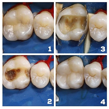 Клинический случай: лечение глубокого кариеса постоянного зуба.