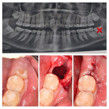 Операция удаления восьмых зубов 