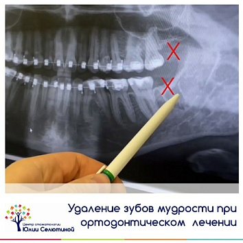 Удаление зуба мудрости по ортодонтическим показаниям. 