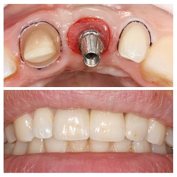 Восстановление трех центральных зубов у взрослого пациента 