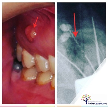 Клинический случай: обломок инструмента в канале зуба.