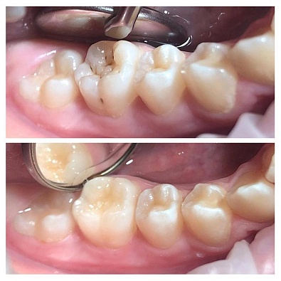 Зачем нужна герметизация зубов?