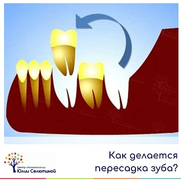 Как делается пересадка зуба? 
