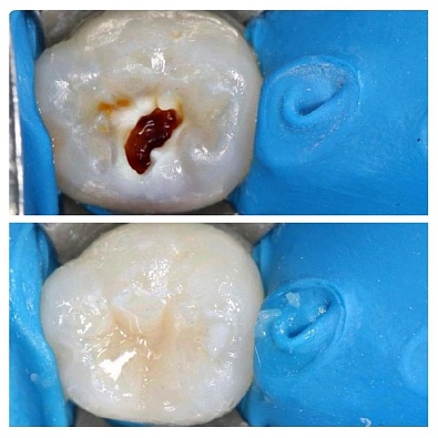 Клинический случай: лечение пульпита молочного зуба 