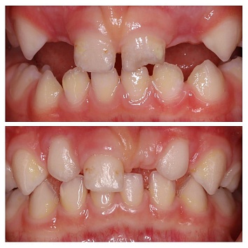 Сроки прорезывания зубов и их индивидуальные особенности 