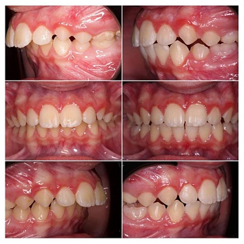 Ортодонтическое лечение в случае задержки развития нижней челюсти.
